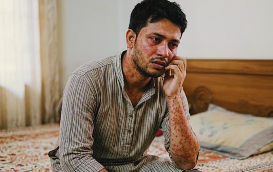 বড়দেরও হচ্ছে হাম: অবহেলা ডেকে আনতে পারে চরম ঝুঁকি!